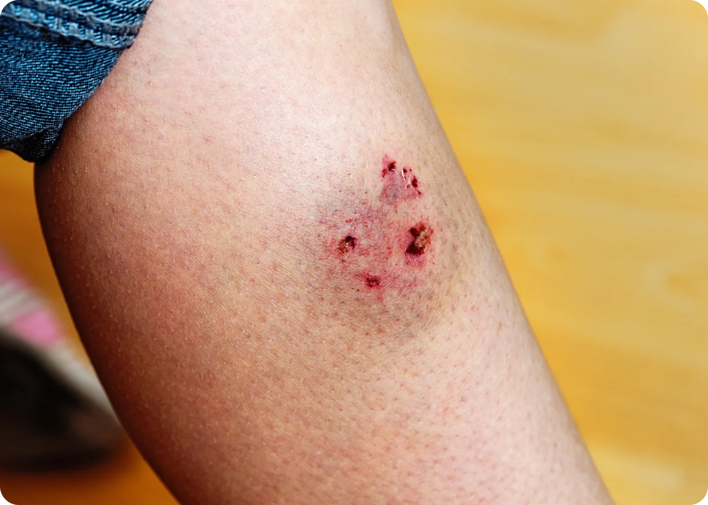 Anti-Rabies Vaccine (Post-Exposure)
