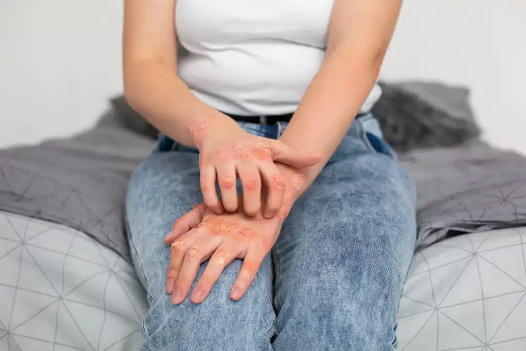 Health Experts Warn Filipinos About the Risks of Shingles